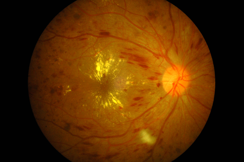 diabetic retinopathy