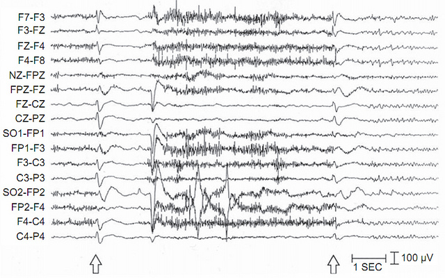 lennox gastaut syndrome