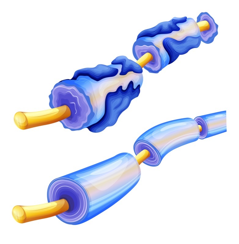 multiple sclerosis