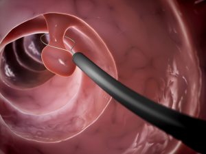 colorectal cancer