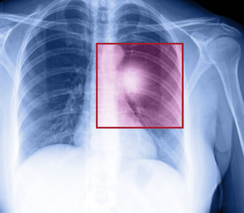 NSCLC lung cancer