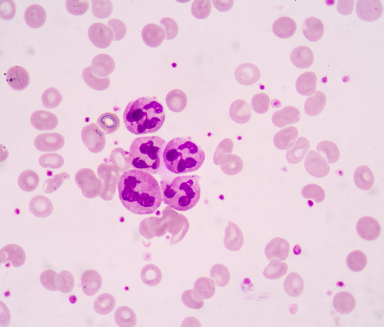 leukemia