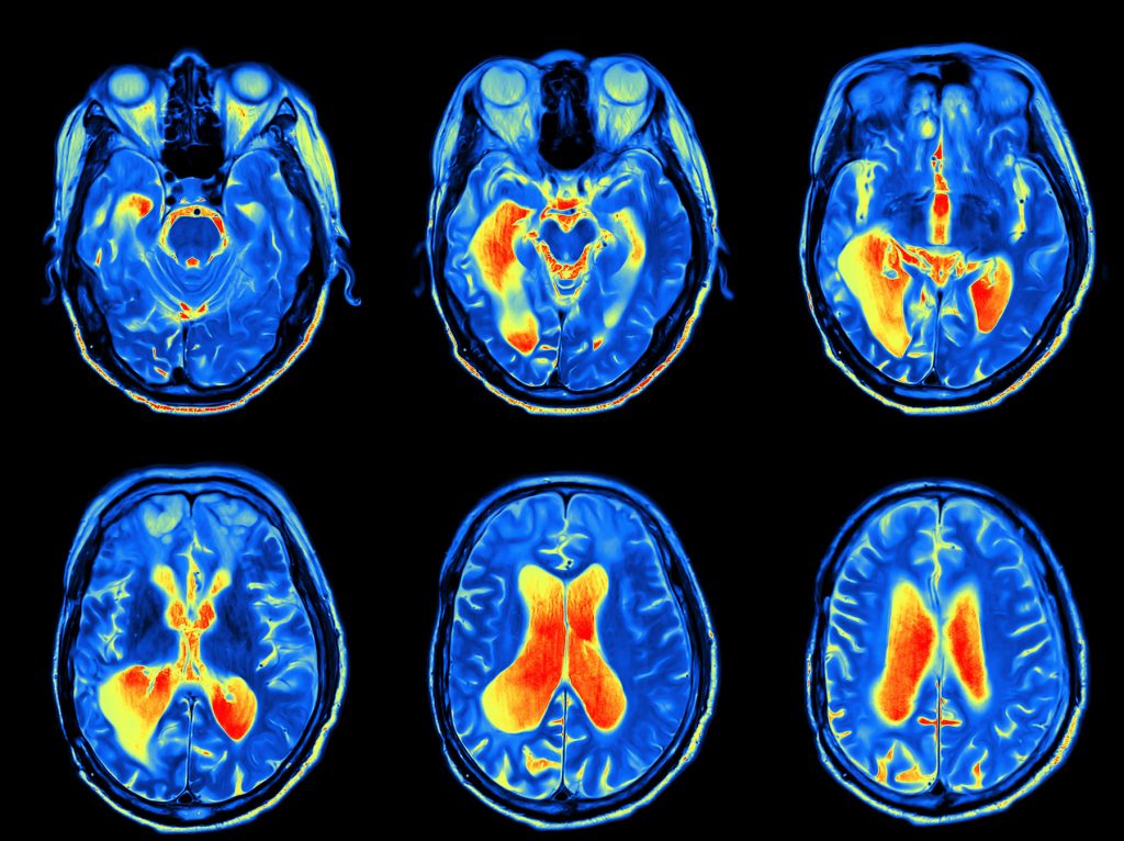 A shared genetic contribution to breast cancer and schizophrenia