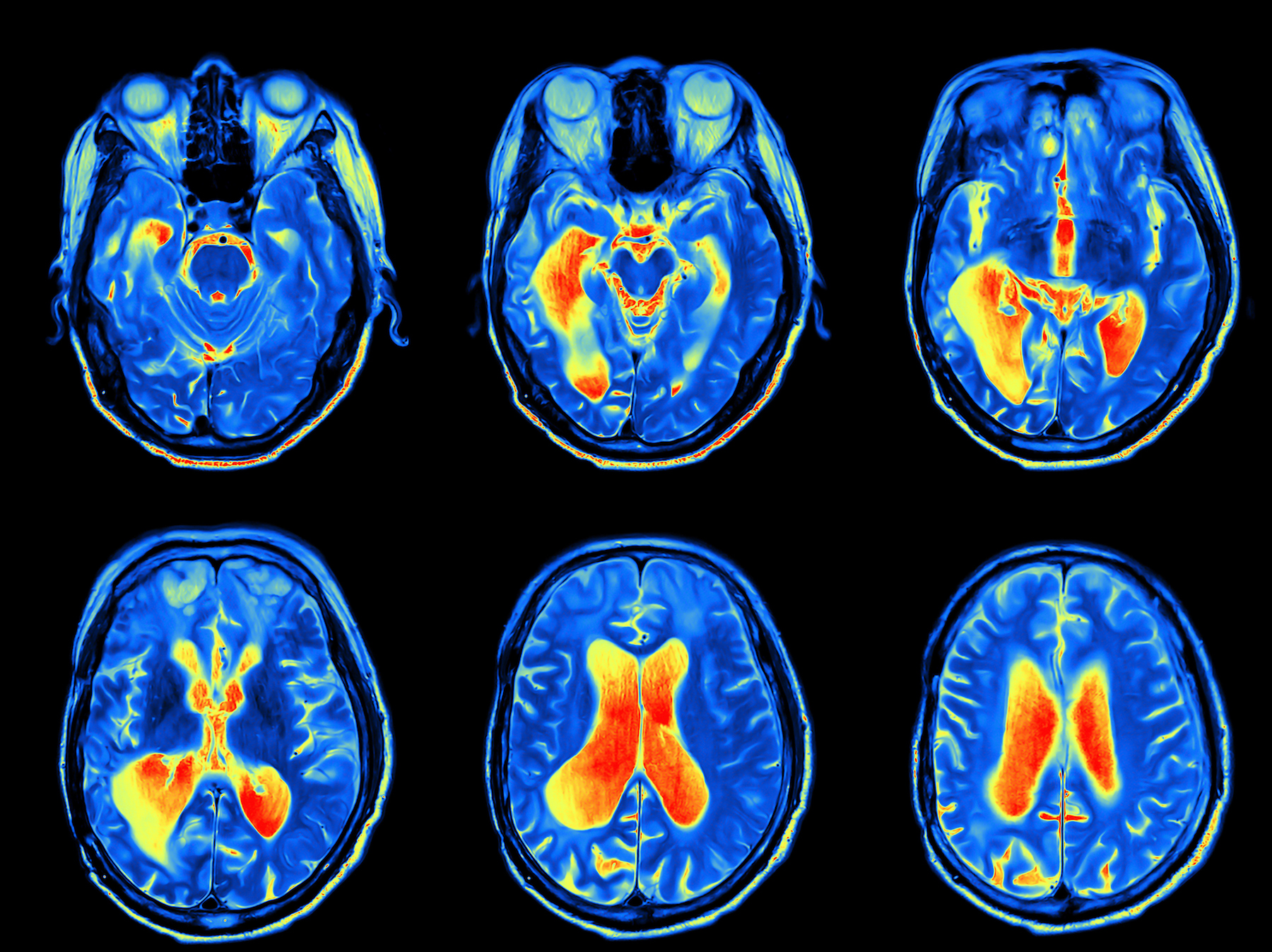 MRI scan image of brain