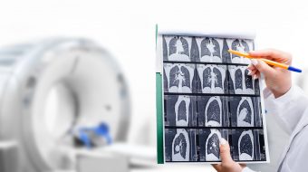 Promoting Equity in Lung Cancer Clinical Trials